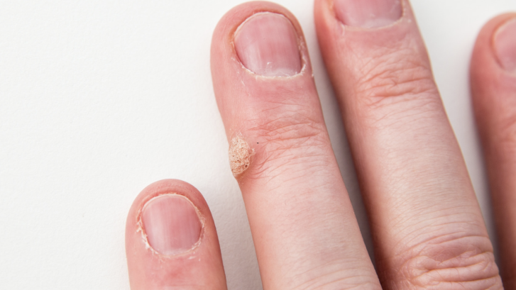 Wart Removal Appointments in St Leonard Maryland